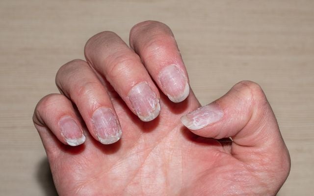 zinc deficiency 6